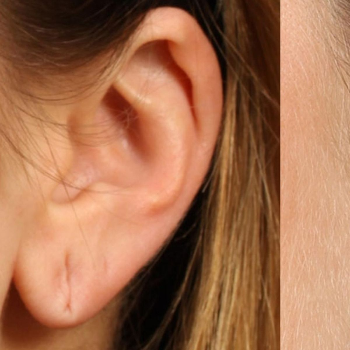 Transform Your Confidence: How Ear Lobe Repair Can Change Your Life