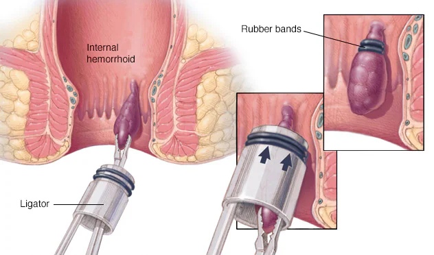 Relieving the Pain: How Banding Treatment Transformed Ankit's Life