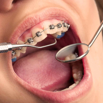 Transforming Smiles and Lives: The Perfect Orthodontic Solution in Warje