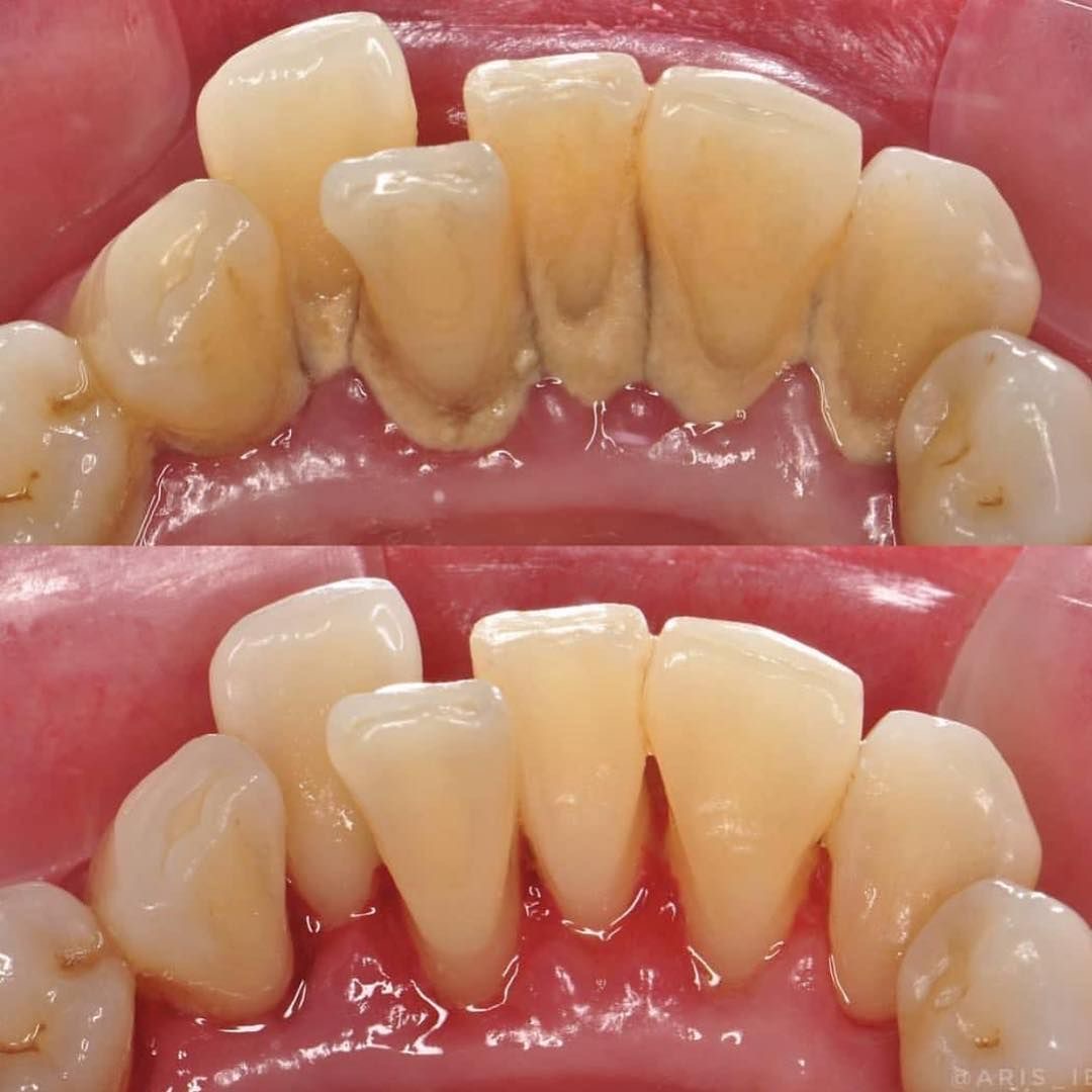 Transforming Smiles: How Scaling Can Revolutionize Your Dental Health