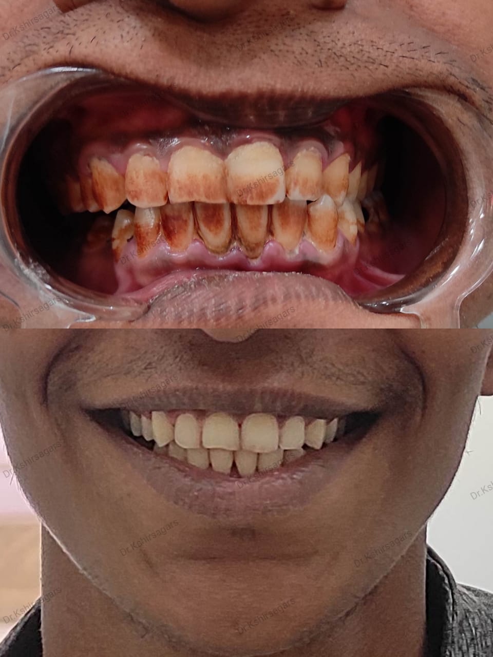 A Radiant Smile Awaits: Transforming Lives with Dental Cleaning and Polishing
