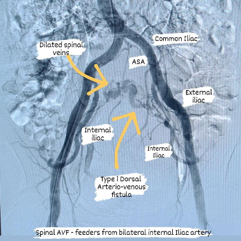 Finding Hope and Healing: The Journey of Overcoming Brain Aneurysms
