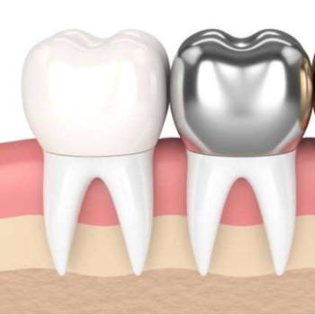 Restoring Smiles: How Dental Crowns Transform Lives