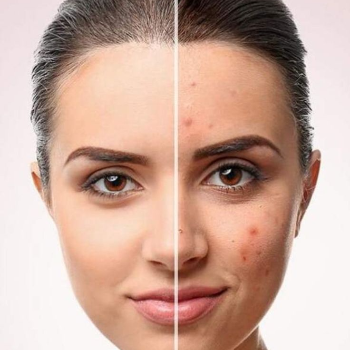 Embrace Clearer Skin: The Journey of Freckles Removal at Tej Skin & Cosmetic Clinic