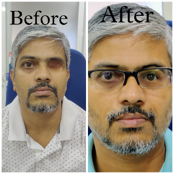 Restoring Confidence: How Silicon Orbital Facial Prosthetics Change Lives | CARE TOUCH VISION CENTRE