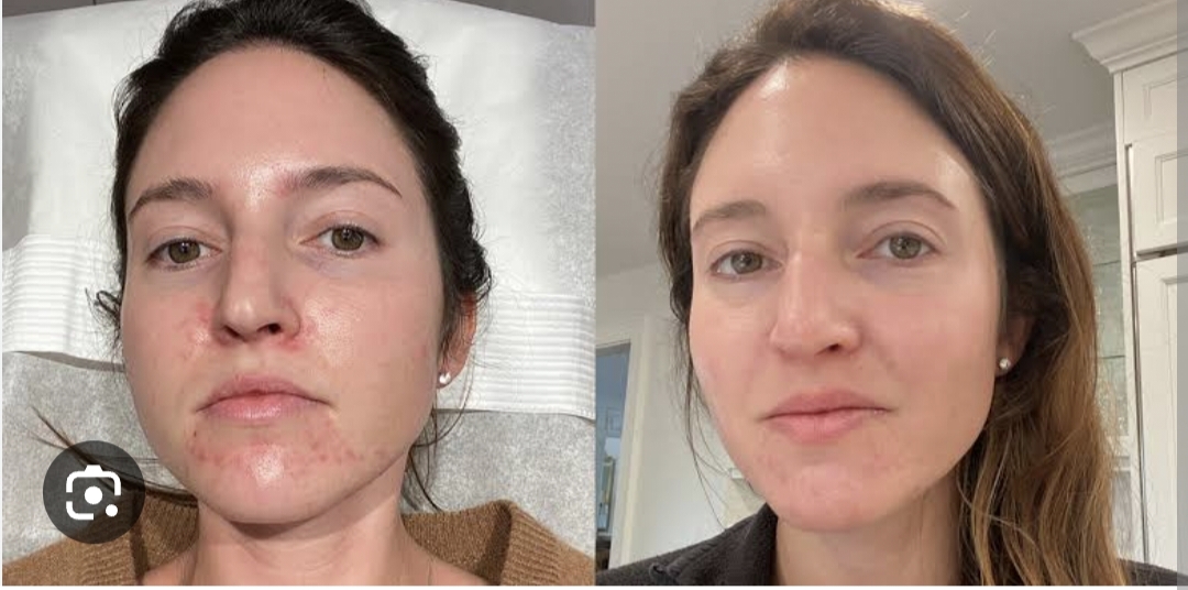 Transform Your Skin and Confidence with Chemical Peeling