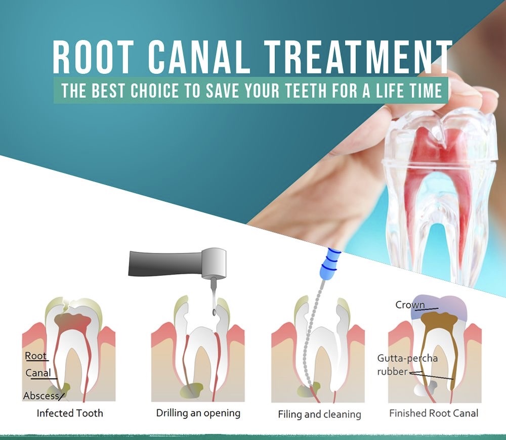 The Transformative Power of a Root Canal: Rekha's Journey to a Pain-Free Smile