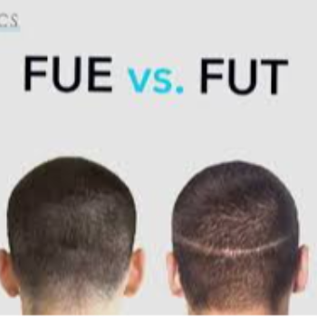 Transforming Lives: How Hair Transplant Techniques Like FUE and FUT Can Help You Rediscover Confidence | Sana Esthetics By Dr. Nakul Somani