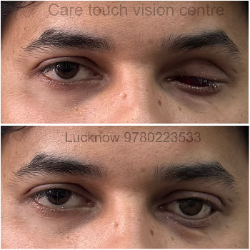 Finding Confidence and Clarity: An Indian Tale of Resilience with Artificial Eyes | CARE TOUCH VISION CENTRE