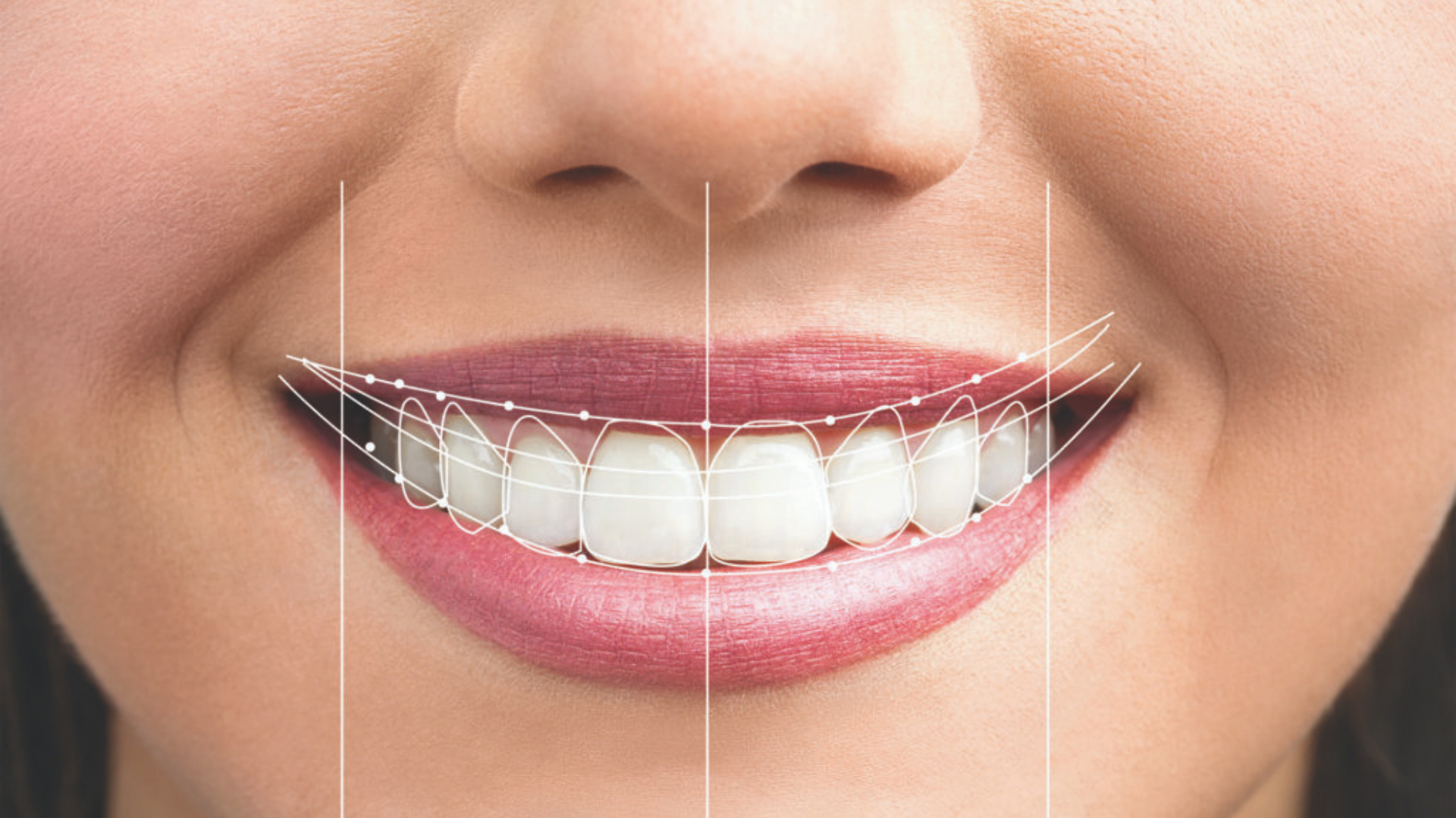 Transform Your Smile, Transform Your Life: An Indian Journey to a Perfect Smile | My family dentist dental implant center (MFD-HARIDWAR)