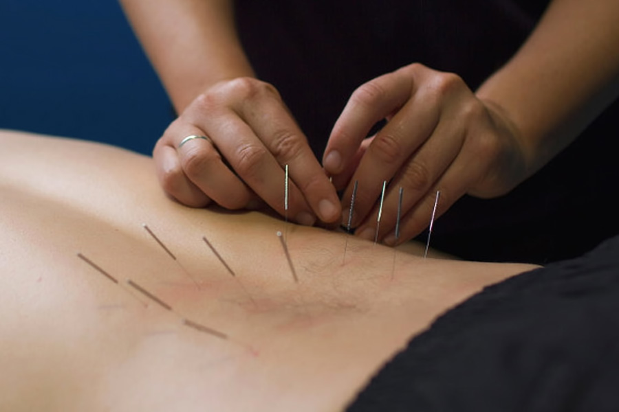 Discover the Healing Power of Dry Needling Therapy: A Journey to Pain-Free Living