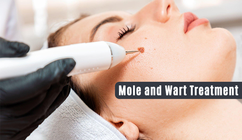 Transforming Lives: How Mole and Wart Removal Can Boost Your Confidence