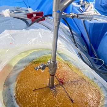 Transforming Lives: How Endoscopic Brain Surgery Offers New Hope