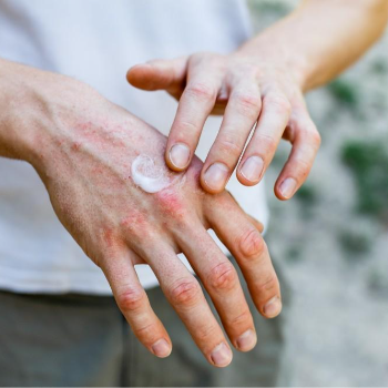 Healing Eczema: Meera's Journey to Clearer Skin