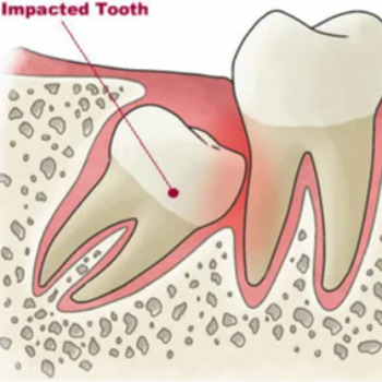 A New Smile Ahead: Solving the Discomfort of Wisdom Tooth Pain