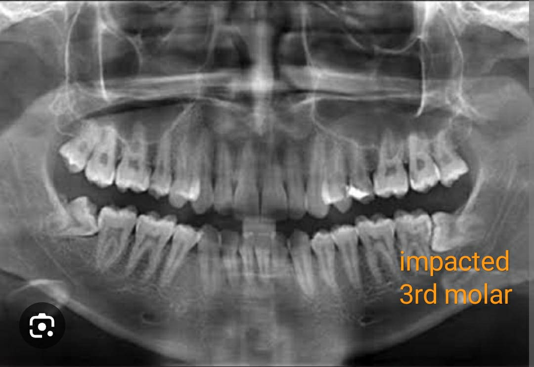 The Journey to a Healthier Smile: Riya's Wisdom Teeth Extraction Story