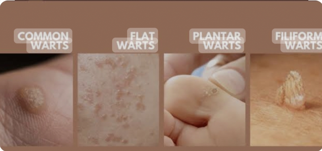 Transforming Confidence: The Journey of Wart and Skin Tag Removal
