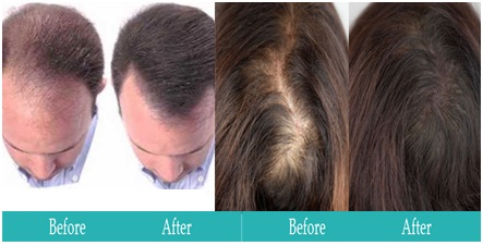 Rediscovering Confidence: How Dr. Narseen Sheikh's Service Transformed My Battle with Hair Loss