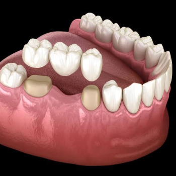 Transforming Smiles, Transforming Lives: The Power of Crowns and Bridges