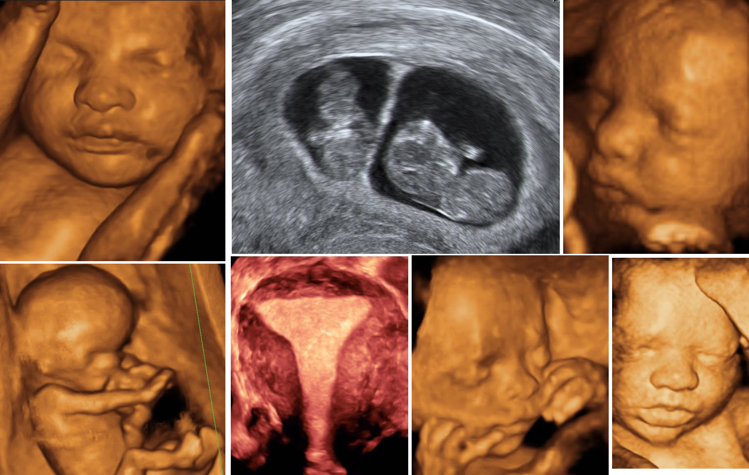 Transforming Pregnancy Journeys: How Obstetric Color Doppler Brings Peace to Expectant Mothers