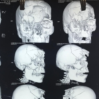 Healing Minds and Restoring Lives: Dr. Jayant Gaud, Your Neurotrauma Specialist