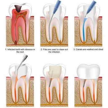 A Pain-Free Smile: How Root Canal Treatment at Smile Care Dental Transformed Priya’s Life