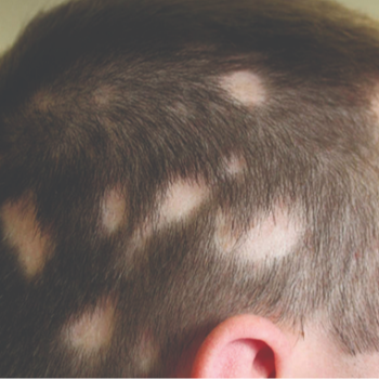 Rediscover Confidence with Hair Patches: A Transformative Journey | Cdrreams