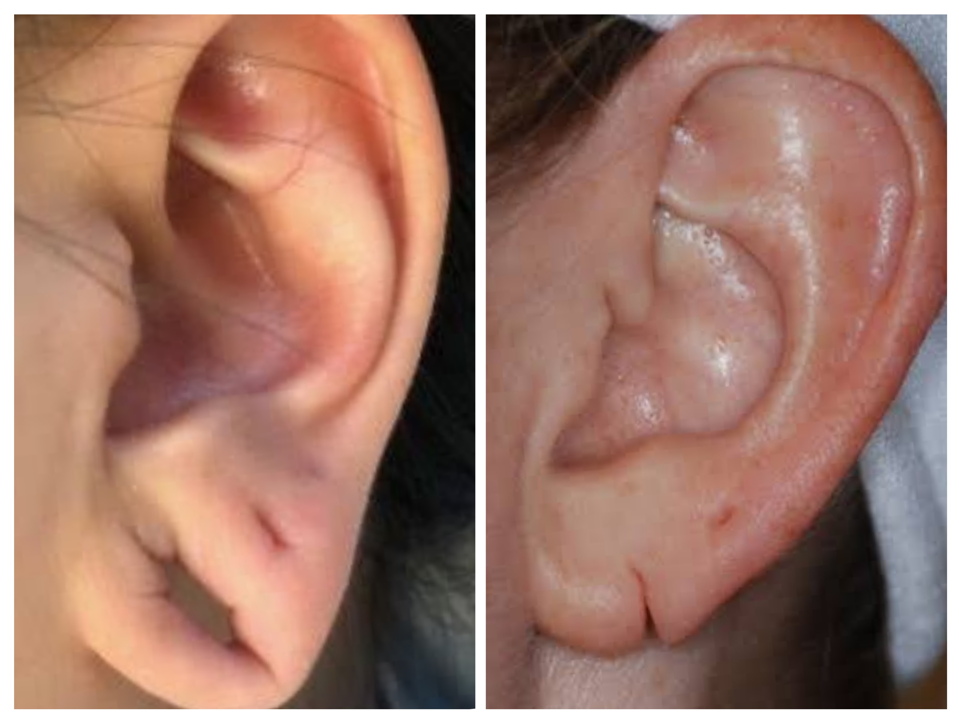 Transforming Lives: The Journey to Self-Confidence Through Ear Lobe Repair