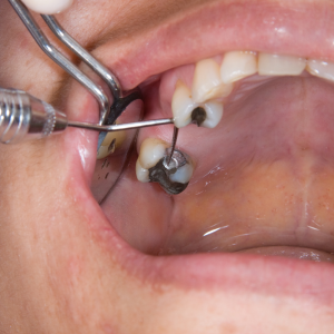Transform Your Smile: A Journey to Full Mouth Rehabilitation