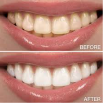 Transform Your Smile: The Journey from Dull to Dazzling with Teeth Whitening