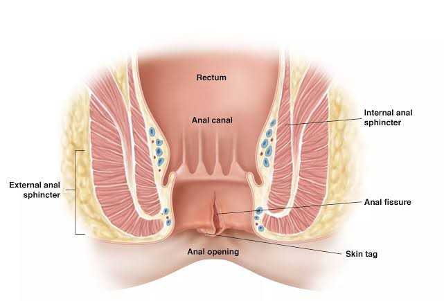 Finding Relief: How YouHeal Speciality Clinic Transformed Rajesh's Life | RADHA CLINIC Piles | Fissure | Fistula | Pilonidal Sinus | Constipation