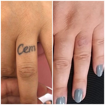 A Fresh Canvas: Transforming Lives with Tattoo Removal