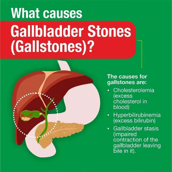 Finding Relief: Rajesh's Journey with Gallbladder Stones and a Life-Changing Solution