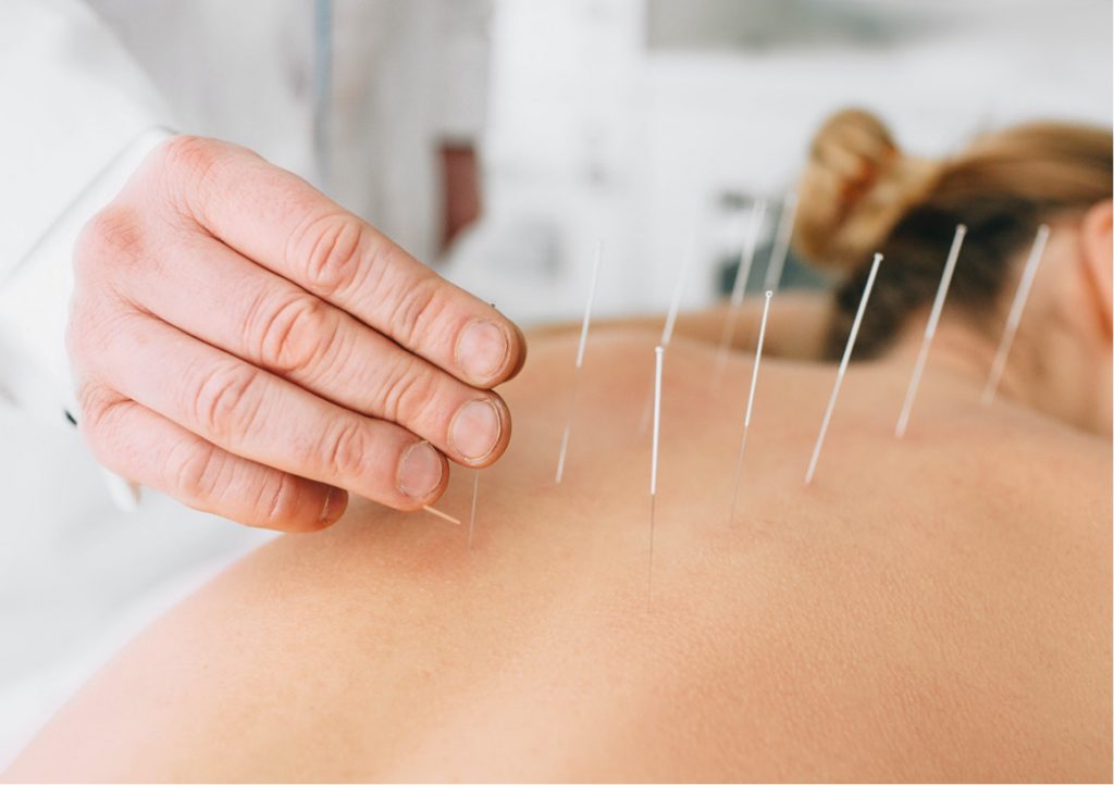 Rediscovering Freedom: How Dry Needling Therapy Transformed Priya's Life