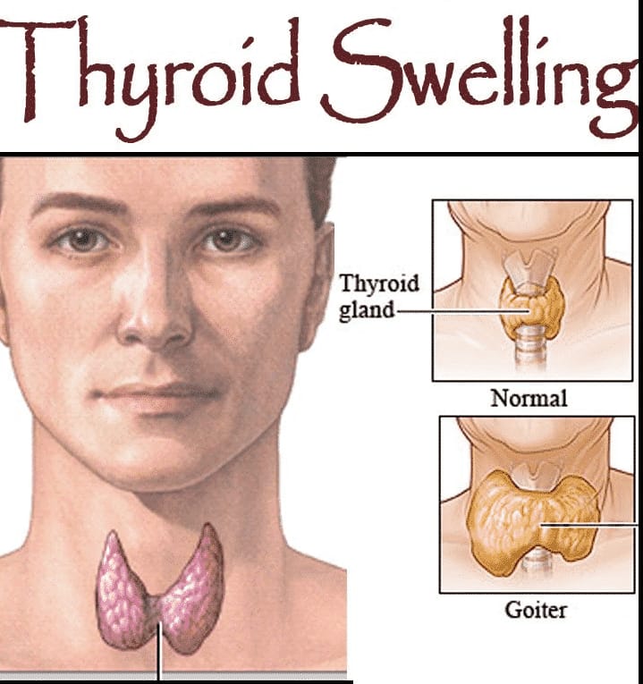 Understanding Thyroid Swelling: A Journey from Concern to Comfort