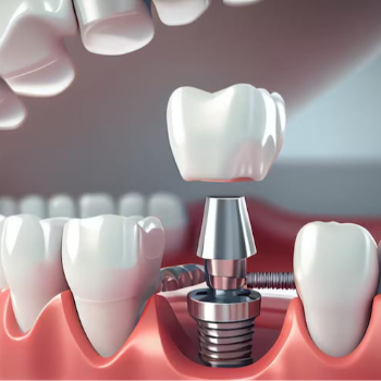 Transforming Smiles: How Dental Implants Changed Rajesh's Life
