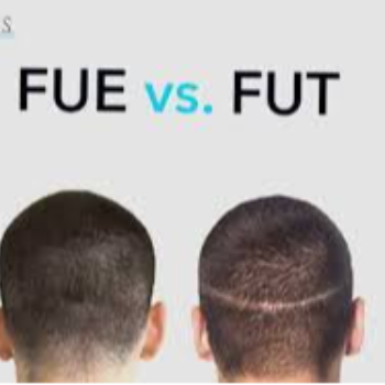 Transforming Lives: How Mega Sessions FUE/FUT Can Restore Confidence and Happiness | Sana Esthetics By Dr. Nakul Somani