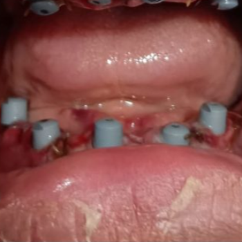 Looking For Dental Implants Near Me