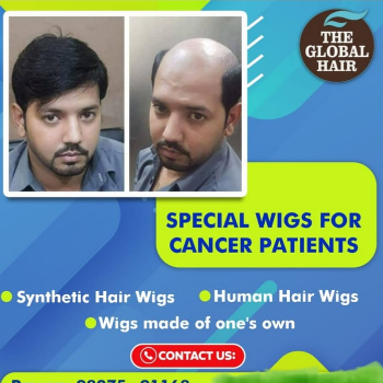 Revolutionizing Hair Replacement Solutions at Global Hair Replacement, Indore.