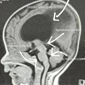 Hope Restored: How Pediatric Neurosurgery Transformed Little Aarav’s Life