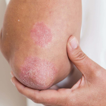 How Shree Lahri Polyclinic Transforms Lives by Treating Fungal Infections