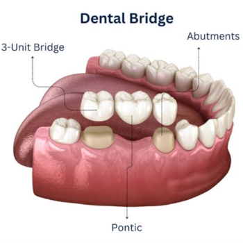 How Ashwin Dental Clinic Transformed Meera’s Life with a Dental Bridge