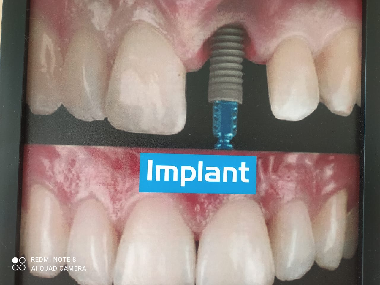 Transform Your Smile and Confidence with Dental Implants: Rajesh's Journey