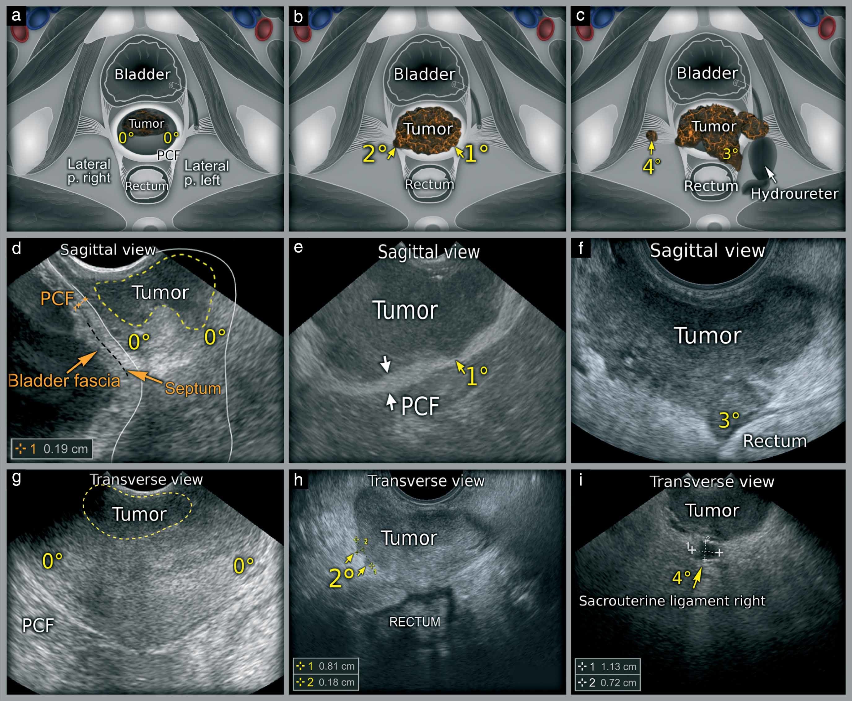 The Ultimate Guide to Whole Abdomen and Pelvic Ultrasonography: A Lifesaver for Ramesh and Priya