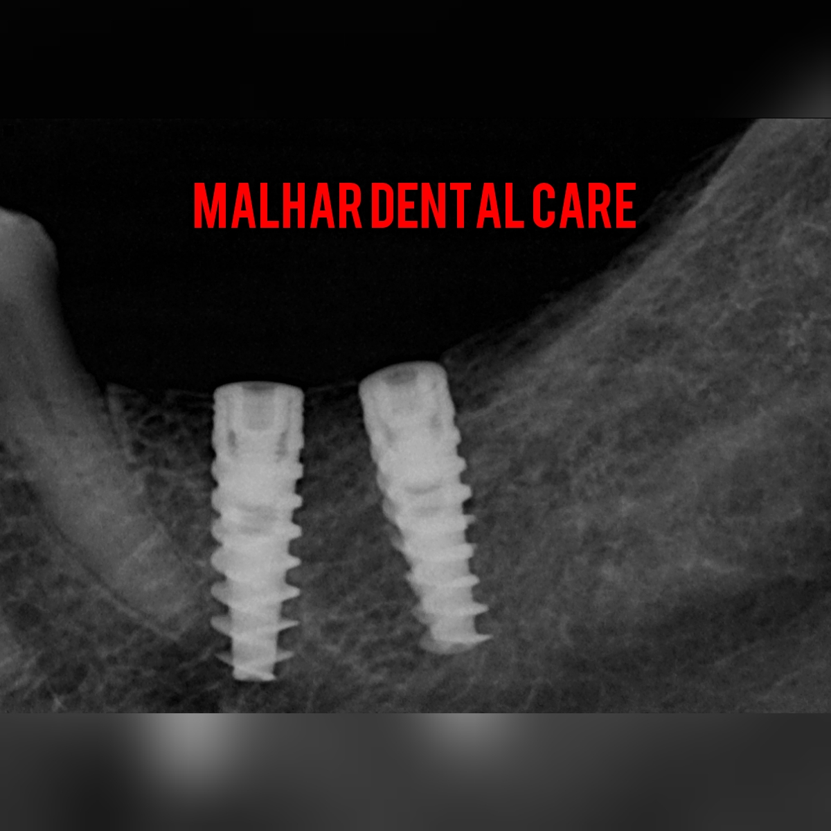 Transform Your Smile and Confidence with Dental Implants at Malhar Dental Clinic