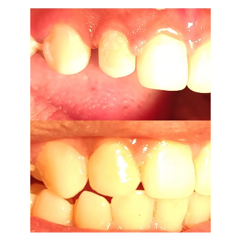 Transform Your Smile Instantly with Composite Laminates at Dr. Kshirsagar's Multispeciality Dental