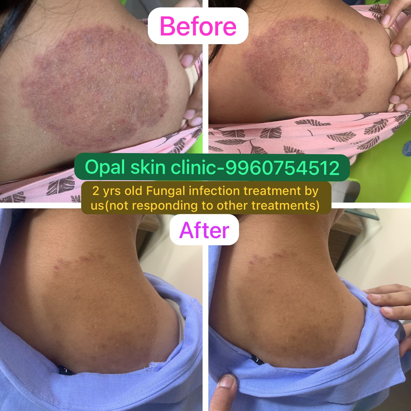 A New Beginning: Overcoming Fungal Infections with Opal Skin Clinic