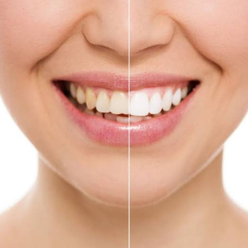 Embrace a Radiant Smile: Transform Your Confidence with Tooth Whitening