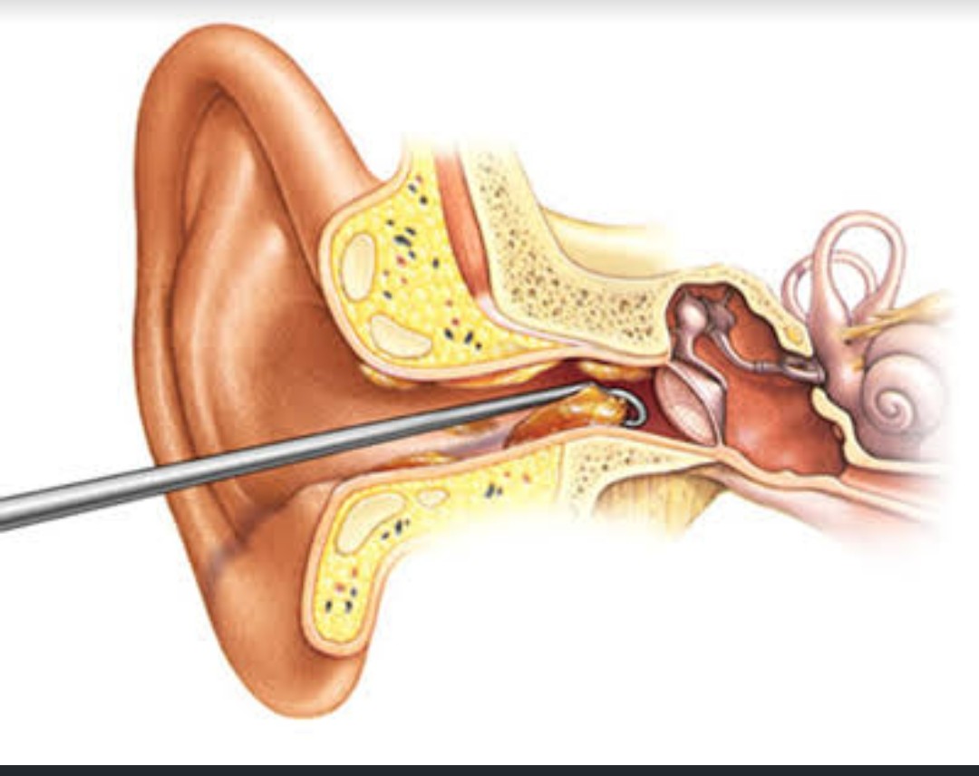 A Journey to Relief: How Surya ENT Care Centre Transformed Anjali's Experience with Ear Foreign Body Removal