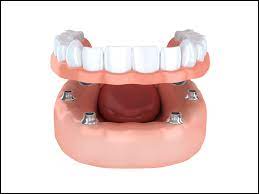 Rediscover Your Smile with Precision Dentures